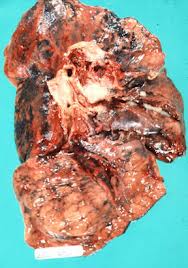 Bronchogenic-carcinoma.jpg