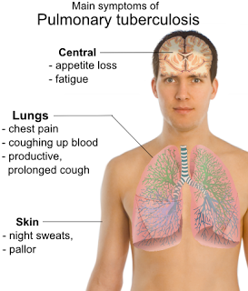Pulmonary-tuberculosis-symptoms.png