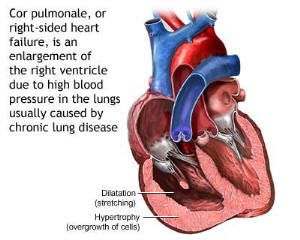 cor-pulmonale.jpg