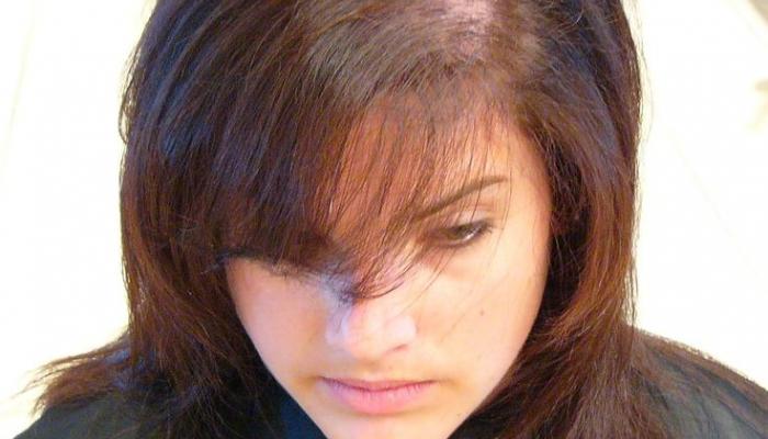 119-085349-causes-symptoms-alopecia-treatment_700x400.jpg